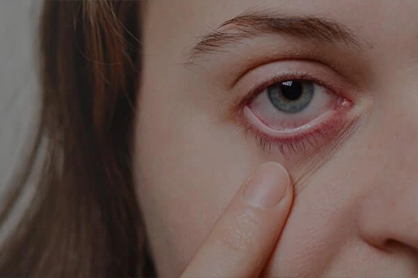Conjuntivitis alergica