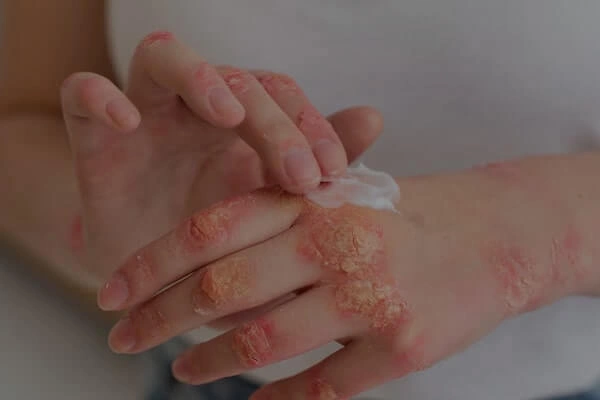 Dermatitis Atopica