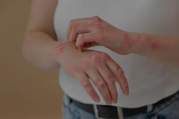 Urticaria